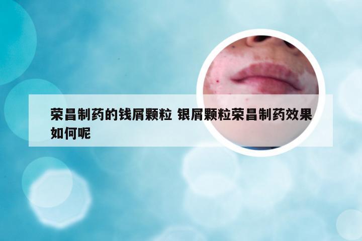 荣昌制药的钱屑颗粒 银屑颗粒荣昌制药效果如何呢