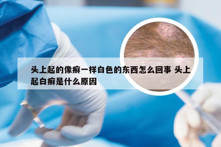 头上起的像癣一样白色的东西怎么回事 头上起白癣是什么原因