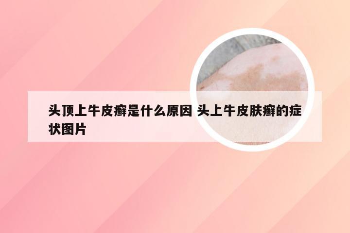 头顶上牛皮癣是什么原因 头上牛皮肤癣的症状图片