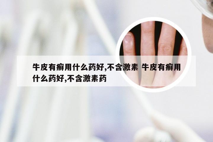 牛皮有癣用什么药好,不含激素 牛皮有癣用什么药好,不含激素药