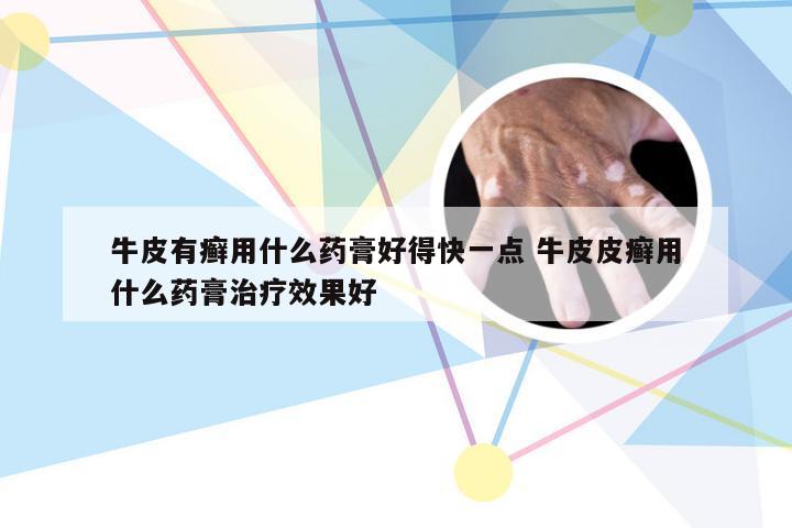 牛皮有癣用什么药膏好得快一点 牛皮皮癣用什么药膏治疗效果好