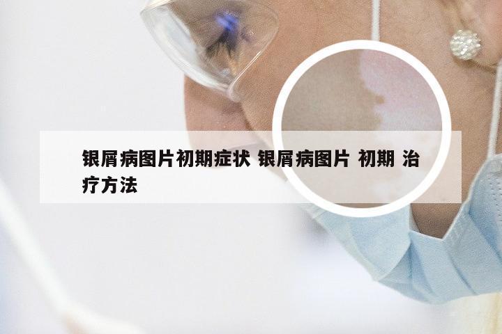 银屑病图片初期症状 银屑病图片 初期 治疗方法