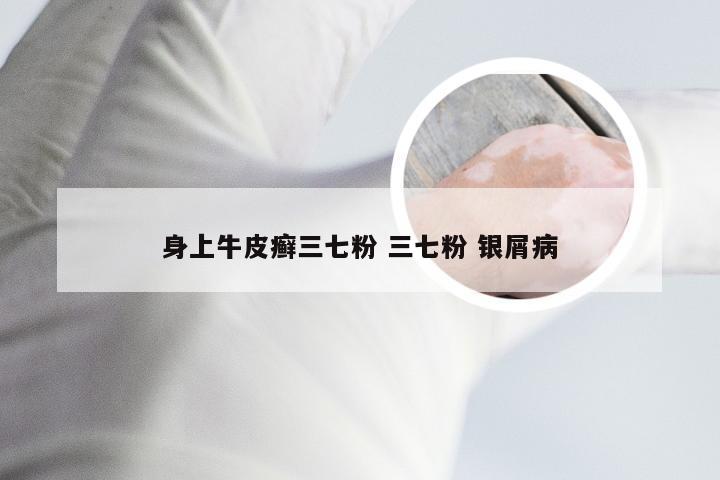 身上牛皮癣三七粉 三七粉 银屑病