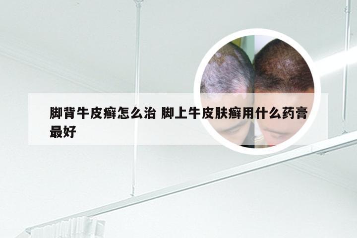 脚背牛皮癣怎么治 脚上牛皮肤癣用什么药膏最好