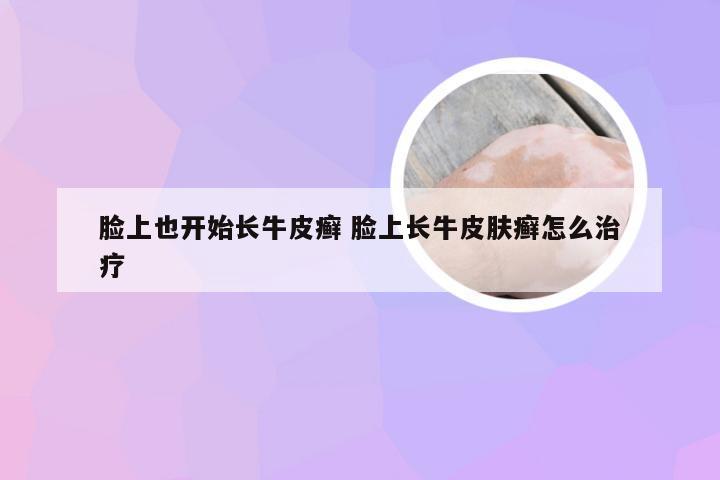 脸上也开始长牛皮癣 脸上长牛皮肤癣怎么治疗