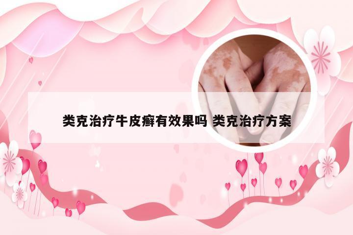 类克治疗牛皮癣有效果吗 类克治疗方案