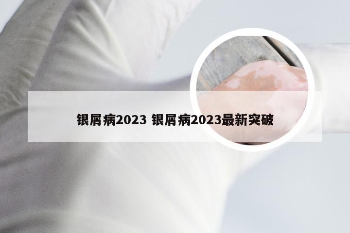 银屑病2023 银屑病2023最新突破