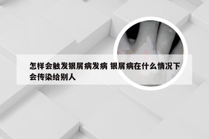 怎样会触发银屑病发病 银屑病在什么情况下会传染给别人