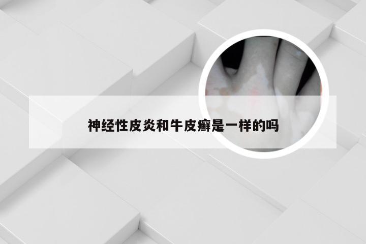 神经性皮炎和牛皮癣是一样的吗