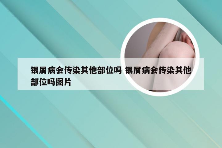 银屑病会传染其他部位吗 银屑病会传染其他部位吗图片