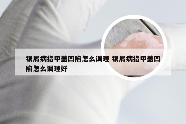 银屑病指甲盖凹陷怎么调理 银屑病指甲盖凹陷怎么调理好