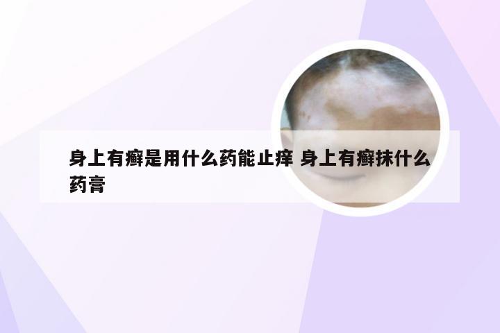 身上有癣是用什么药能止痒 身上有癣抹什么药膏