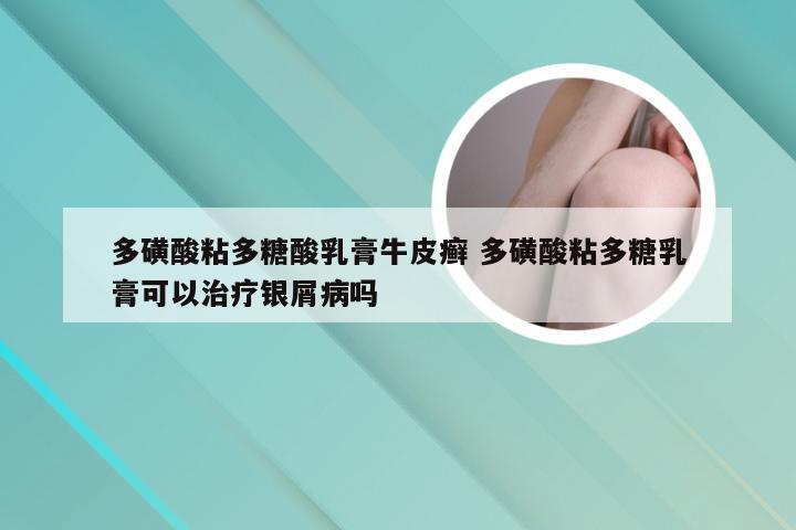 多磺酸粘多糖酸乳膏牛皮癣 多磺酸粘多糖乳膏可以治疗银屑病吗