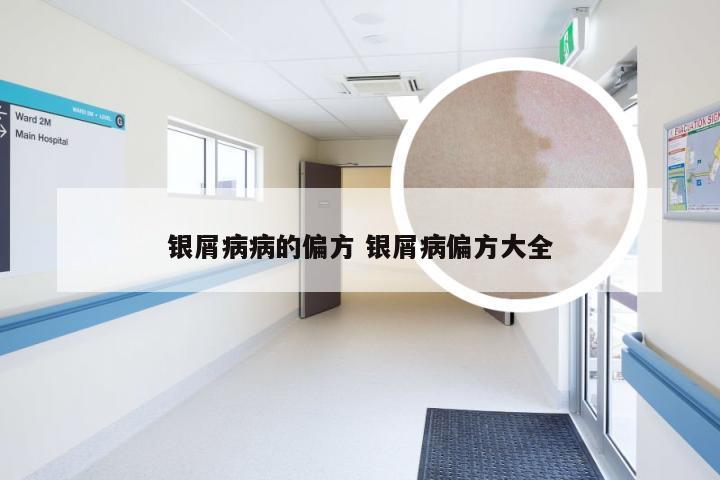 银屑病病的偏方 银屑病偏方大全