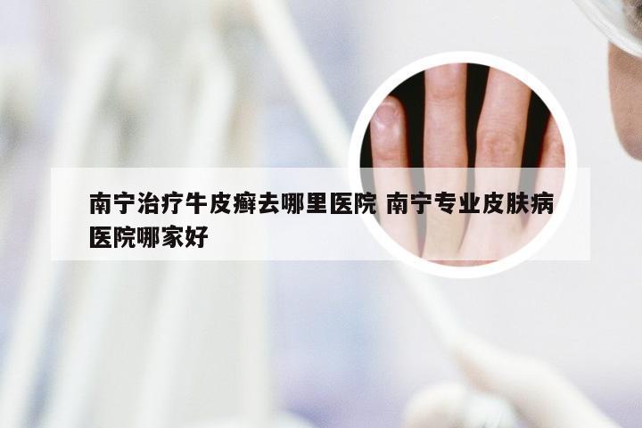 南宁治疗牛皮癣去哪里医院 南宁专业皮肤病医院哪家好