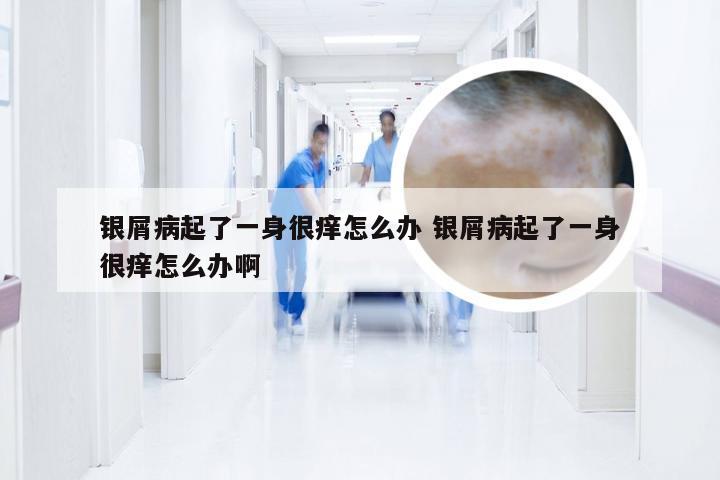 银屑病起了一身很痒怎么办 银屑病起了一身很痒怎么办啊