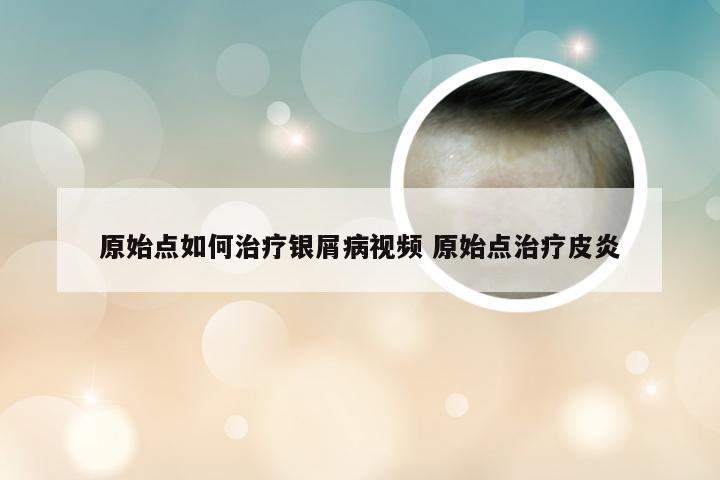 原始点如何治疗银屑病视频 原始点治疗皮炎