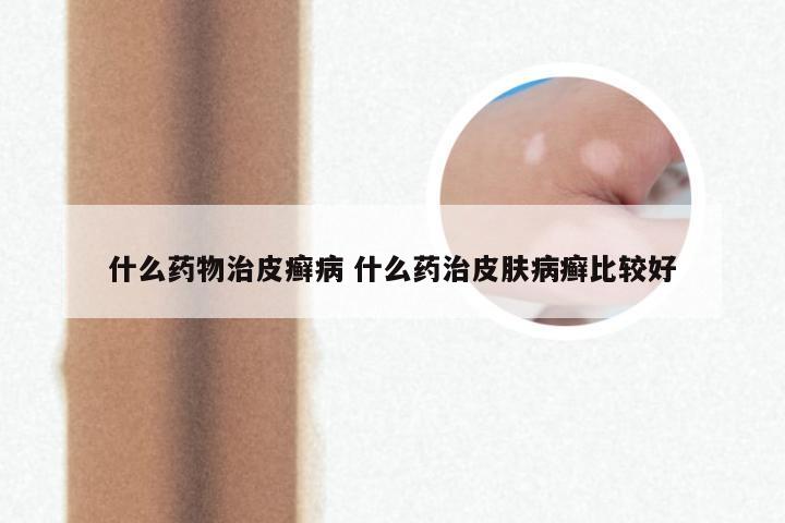 什么药物治皮癣病 什么药治皮肤病癣比较好
