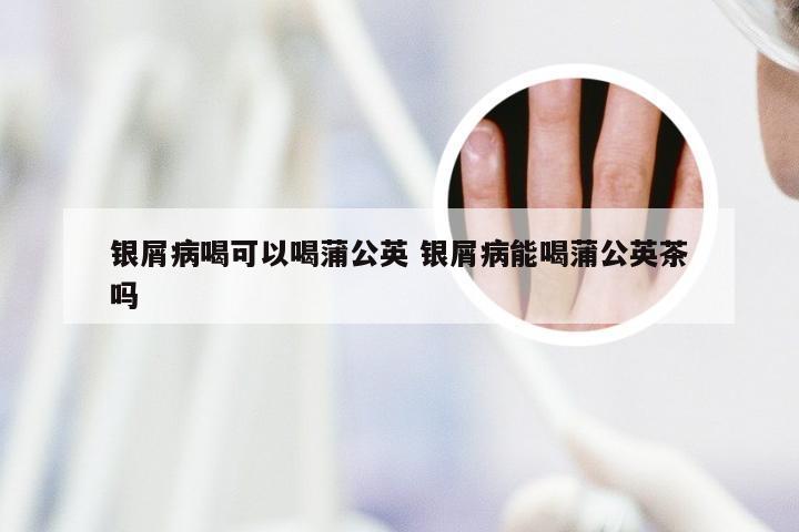 银屑病喝可以喝蒲公英 银屑病能喝蒲公英茶吗