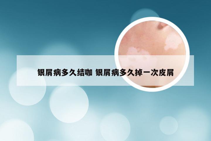银屑病多久结咖 银屑病多久掉一次皮屑