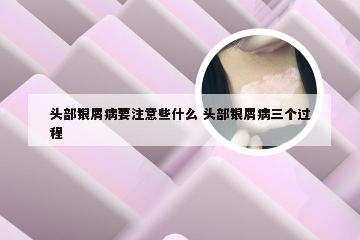 头部银屑病要注意些什么 头部银屑病三个过程
