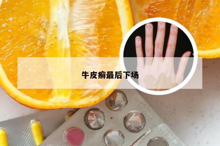 牛皮癣最后下场