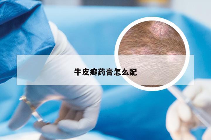 牛皮癣药膏怎么配