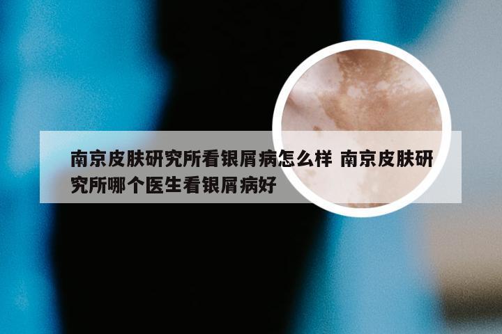 南京皮肤研究所看银屑病怎么样 南京皮肤研究所哪个医生看银屑病好