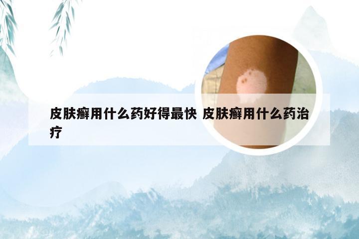 皮肤癣用什么药好得最快 皮肤癣用什么药治疗