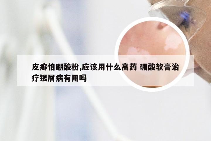 皮癣怕硼酸粉,应该用什么高药 硼酸软膏治疗银屑病有用吗