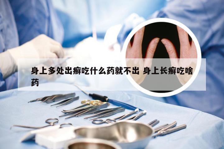 身上多处出癣吃什么药就不出 身上长癣吃啥药