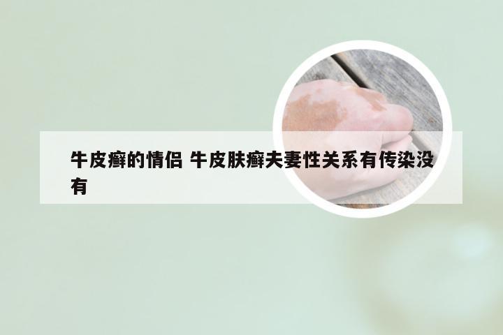 牛皮癣的情侣 牛皮肤癣夫妻性关系有传染没有