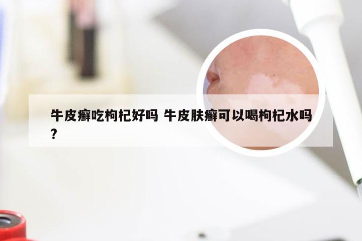 牛皮癣吃枸杞好吗 牛皮肤癣可以喝枸杞水吗?