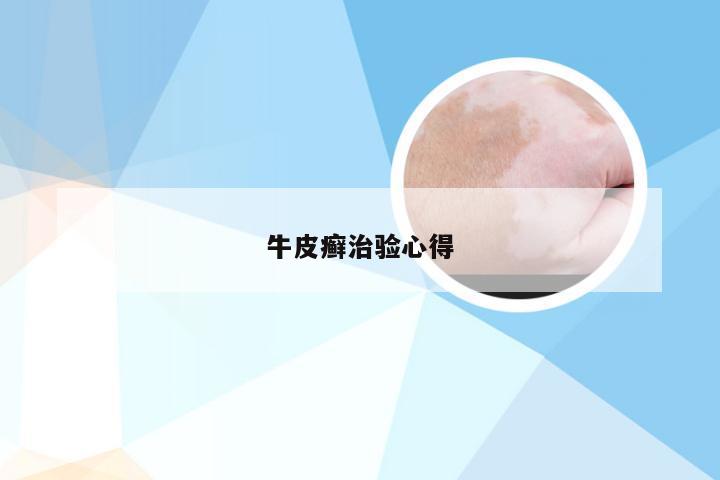 牛皮癣治验心得