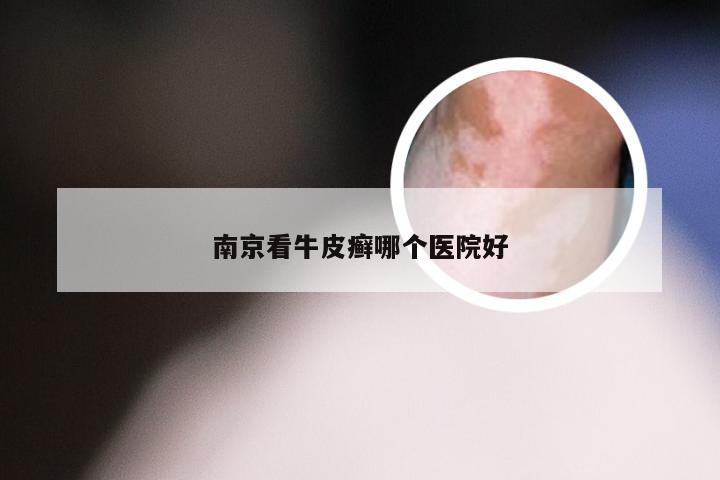 南京看牛皮癣哪个医院好