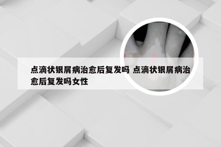 点滴状银屑病治愈后复发吗 点滴状银屑病治愈后复发吗女性