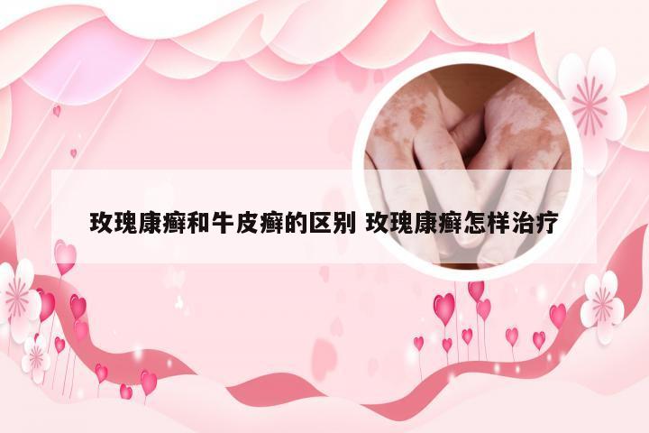 玫瑰康癣和牛皮癣的区别 玫瑰康癣怎样治疗