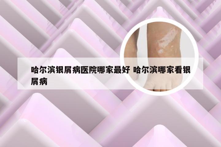 哈尔滨银屑病医院哪家最好 哈尔滨哪家看银屑病