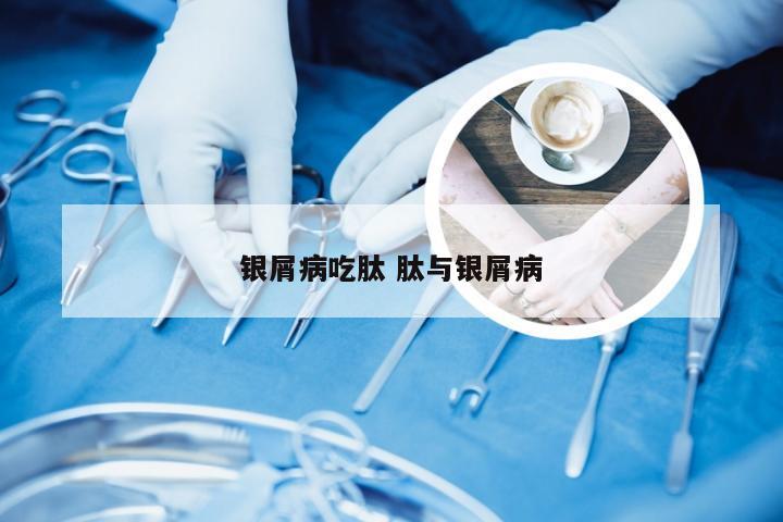 银屑病吃肽 肽与银屑病