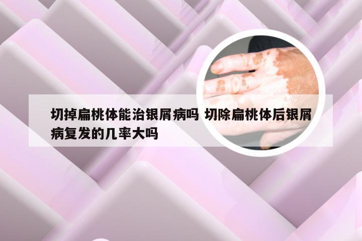 切掉扁桃体能治银屑病吗 切除扁桃体后银屑病复发的几率大吗
