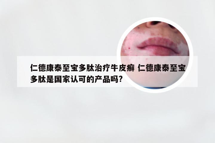 仁德康泰至宝多肽治疗牛皮癣 仁德康泰至宝多肽是国家认可的产品吗?