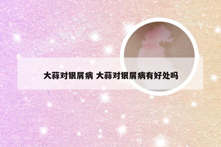 大蒜对银屑病 大蒜对银屑病有好处吗