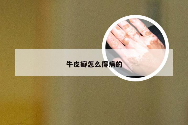 牛皮癣怎么得病的