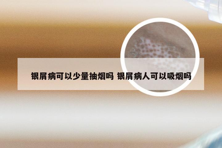 银屑病可以少量抽烟吗 银屑病人可以吸烟吗