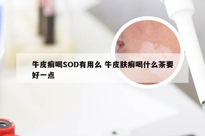 牛皮癣喝SOD有用么 牛皮肤癣喝什么茶要好一点