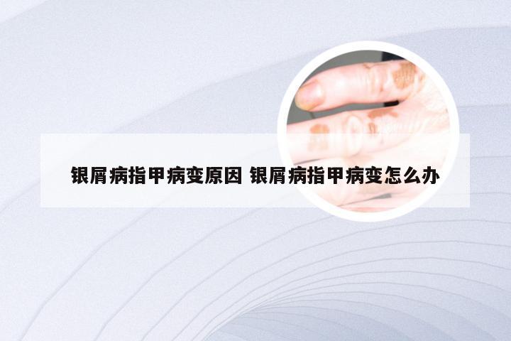 银屑病指甲病变原因 银屑病指甲病变怎么办