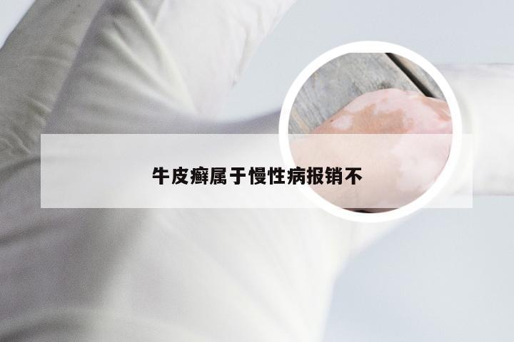 牛皮癣属于慢性病报销不