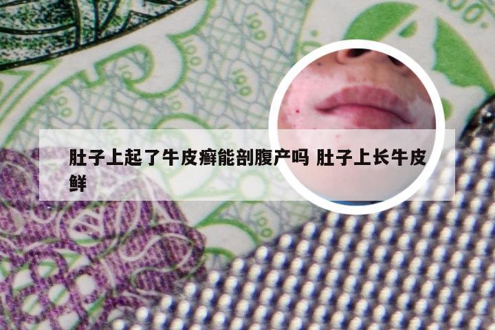 肚子上起了牛皮癣能剖腹产吗 肚子上长牛皮鲜