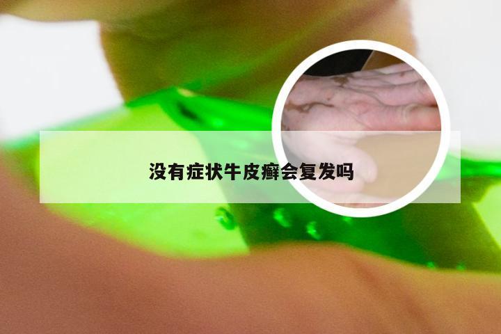 没有症状牛皮癣会复发吗