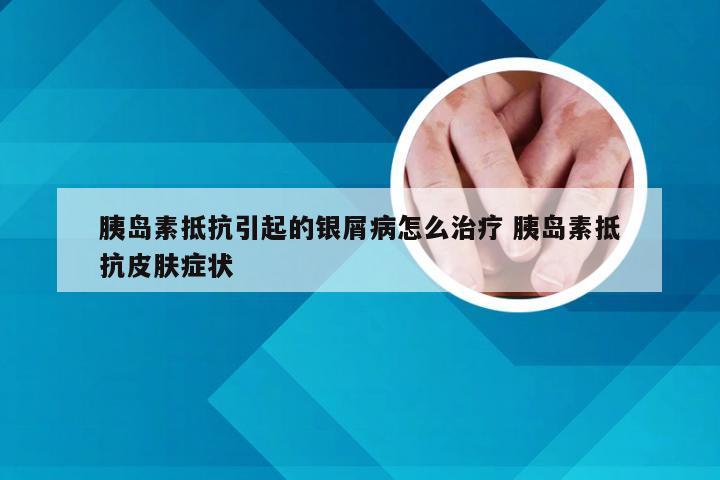 胰岛素抵抗引起的银屑病怎么治疗 胰岛素抵抗皮肤症状